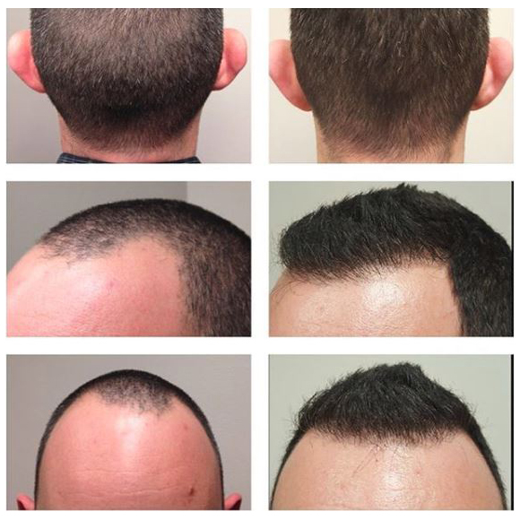 treatment of thinning hair on male patient with FUT