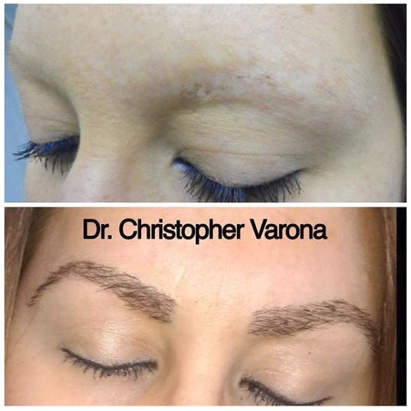 treatment of female patient with trichotillomania of eyebrows