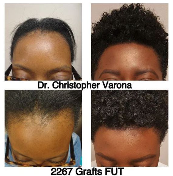 African American woman's hairline restoration after 10 months and FUT treatment