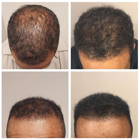 African American hair restoration with manual FUE grafts