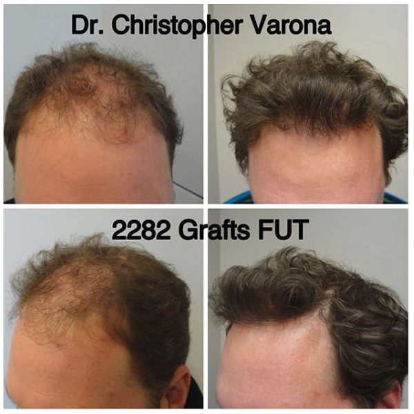 treatment of miniaturized hair with FUT graft on male patient
