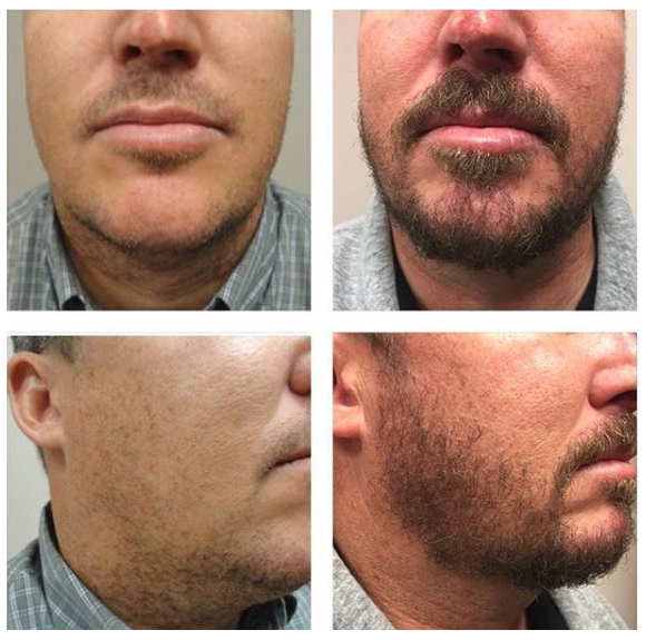 Facial Hair Transplant Newport Beach | Beard Implant | Dr. Varona
