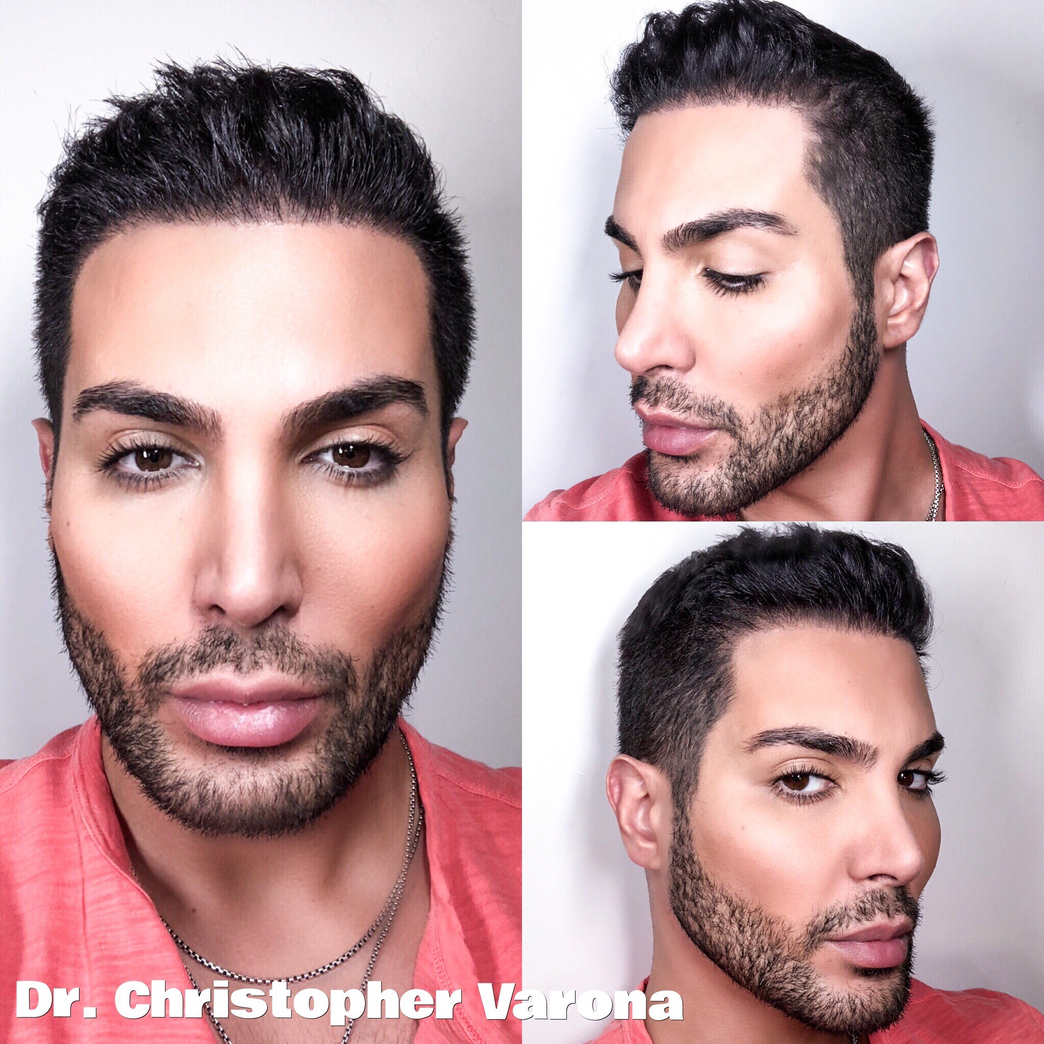 Hair Restoration Before After Newport Beach FUE Pictures Dr Varona
