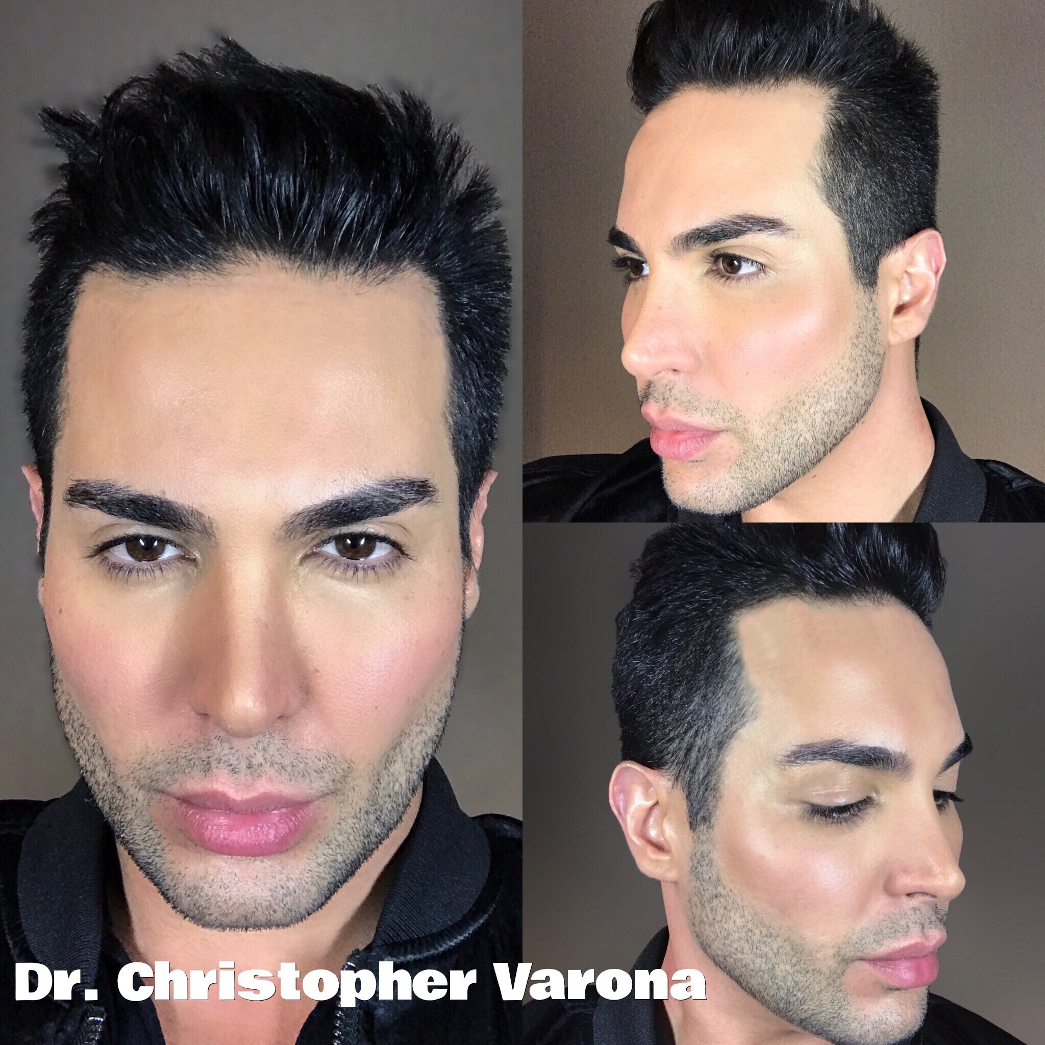 Hair Restoration Before & After Newport Beach | FUE Pictures | Dr. Varona