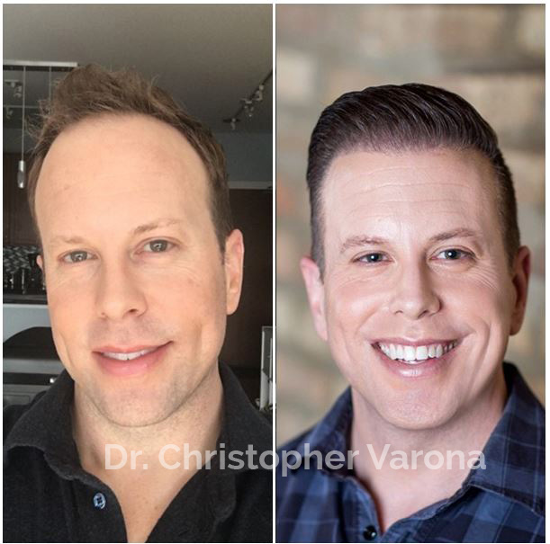 Hair Restoration Before After Newport Beach FUE Pictures Dr Varona